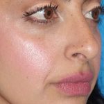 Rhinoplasty Before & After Patient #887
