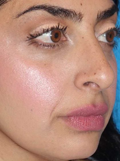 Rhinoplasty Before & After Patient #887
