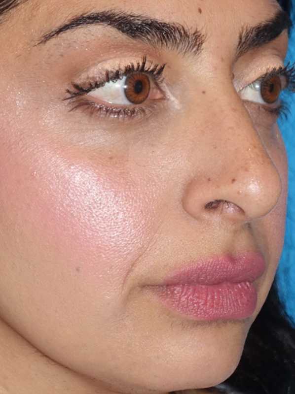 Rhinoplasty Before & After Patient #887