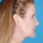 FaceTite Before & After Patient #704