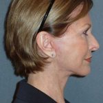 Deep Plane Lower Face & Neck Lift Before & After Patient #920