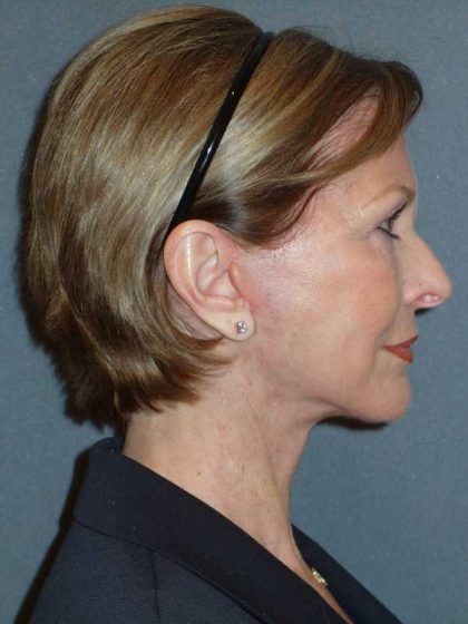 Deep Plane Lower Face & Neck Lift Before & After Patient #920