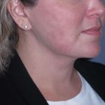Deep Plane Lower Face & Neck Lift Before & After Patient #947