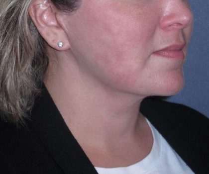 Deep Plane Lower Face & Neck Lift Before & After Patient #947