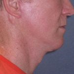 Deep Plane Mini Lift & Neck Lift Before & After Patient #965