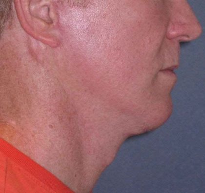 Deep Plane Mini Lift & Neck Lift Before & After Patient #965