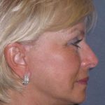 Deep Plane Mini Lift & Neck Lift Before & After Patient #972