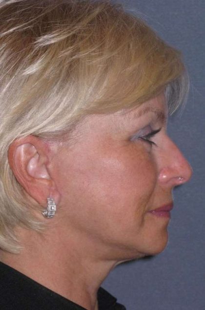 Deep Plane Mini Lift & Neck Lift Before & After Patient #972