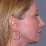 Deep Plane Mini Lift & Neck Lift Before & After Patient #981