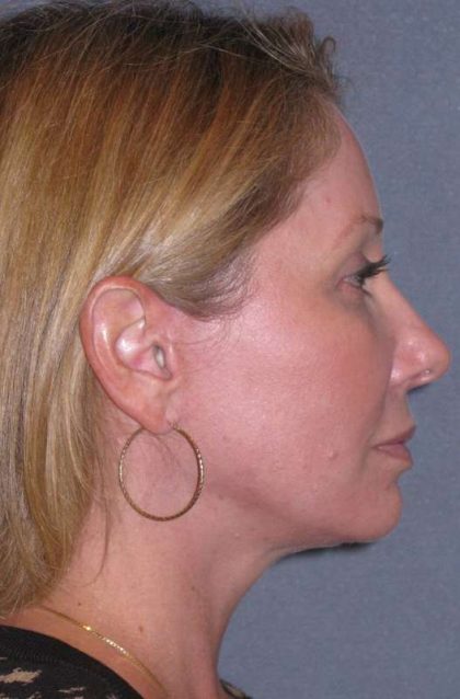 Deep Plane Mini Lift & Neck Lift Before & After Patient #981