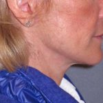 Deep Plane Mini Lift & Neck Lift Before & After Patient #988