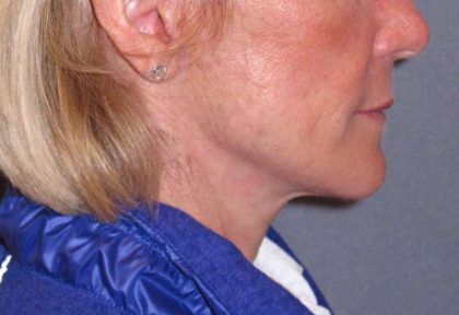 Deep Plane Mini Lift & Neck Lift Before & After Patient #988