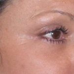 Fat Transfer Before & After Patient #715