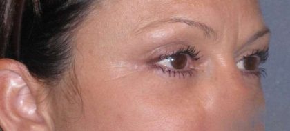 Fat Transfer Before & After Patient #715