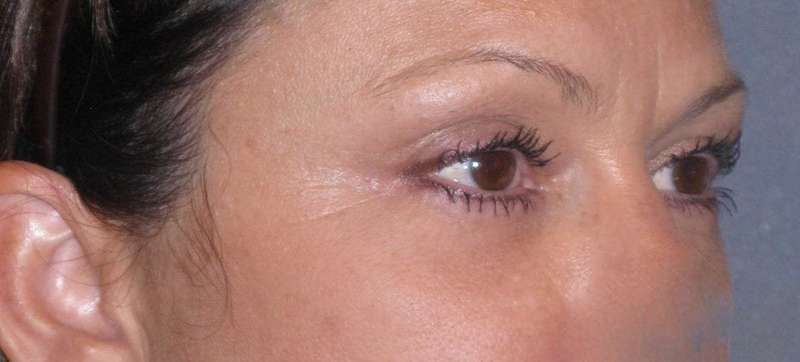 Fat Transfer Before & After Patient #715