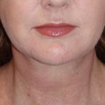 Neck Lift Before & After Patient #1018