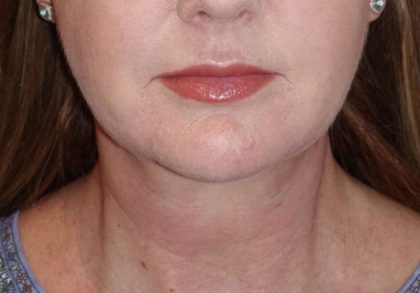 Neck Lift Before & After Patient #1018