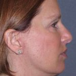 Deep Plane Mini Lift & Neck Lift Before & After Patient #1030