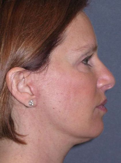 Deep Plane Mini Lift & Neck Lift Before & After Patient #1030