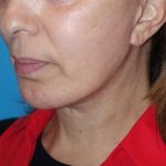 Deep Plane Lower Face & Neck Lift Before & After Patient #1041