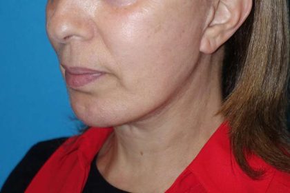 Deep Plane Lower Face & Neck Lift Before & After Patient #1041