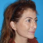Deep Plane Lower Face & Neck Lift Before & After Patient #1052