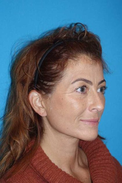 Deep Plane Lower Face & Neck Lift Before & After Patient #1052