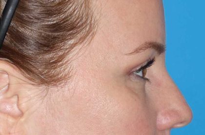 Eyelid Lift- Lower Before & After Patient #731