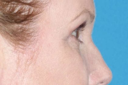 Eyelid Lift- Lower Before & After Patient #742