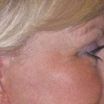 Eyelid Lift- Upper Before & After Patient #754