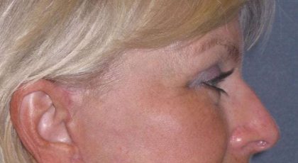 Eyelid Lift- Upper Before & After Patient #754