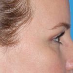 Eyelid Lift- Upper Before & After Patient #765