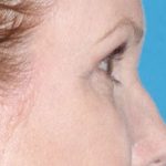 Eyelid Lift- Upper Before & After Patient #776