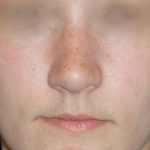 Rhinoplasty Before & After Patient #787