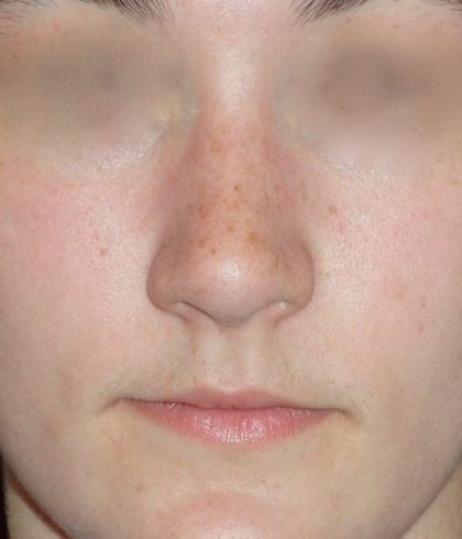Rhinoplasty Before & After Patient #787