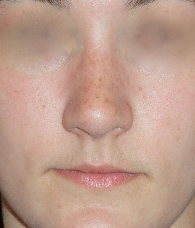 Rhinoplasty Before & After Patient #787