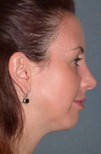 Fraxel Restore Before & After Patient #677