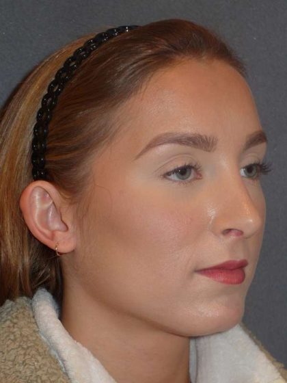 Rhinoplasty Before & After Patient #845