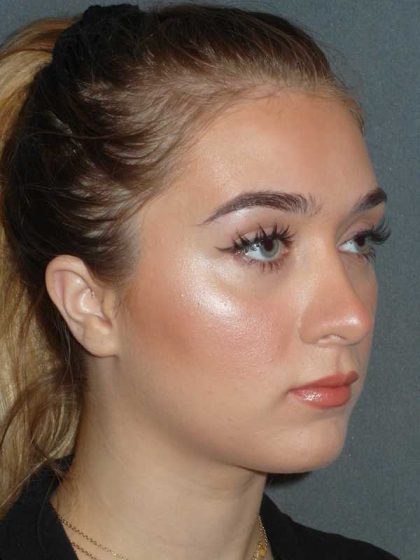 Rhinoplasty Before & After Patient #856