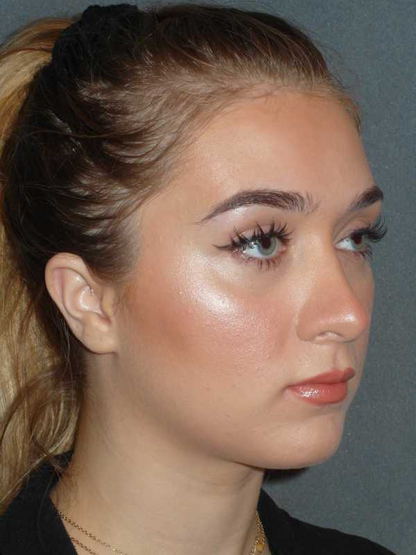 Rhinoplasty Before & After Patient #856