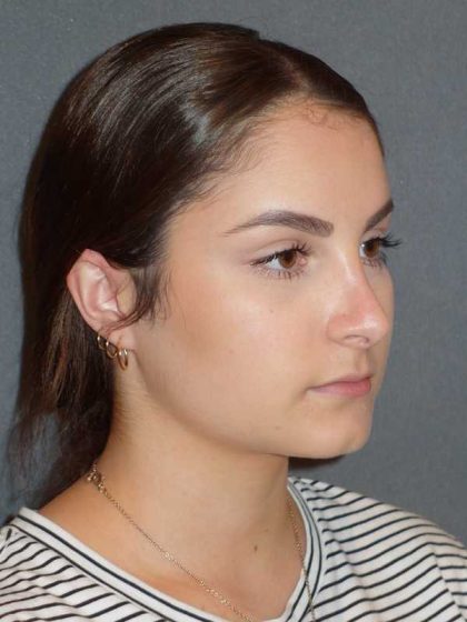 Rhinoplasty Before & After Patient #867
