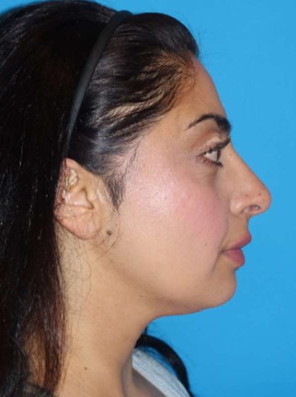 Rhinoplasty Before & After Patient #887