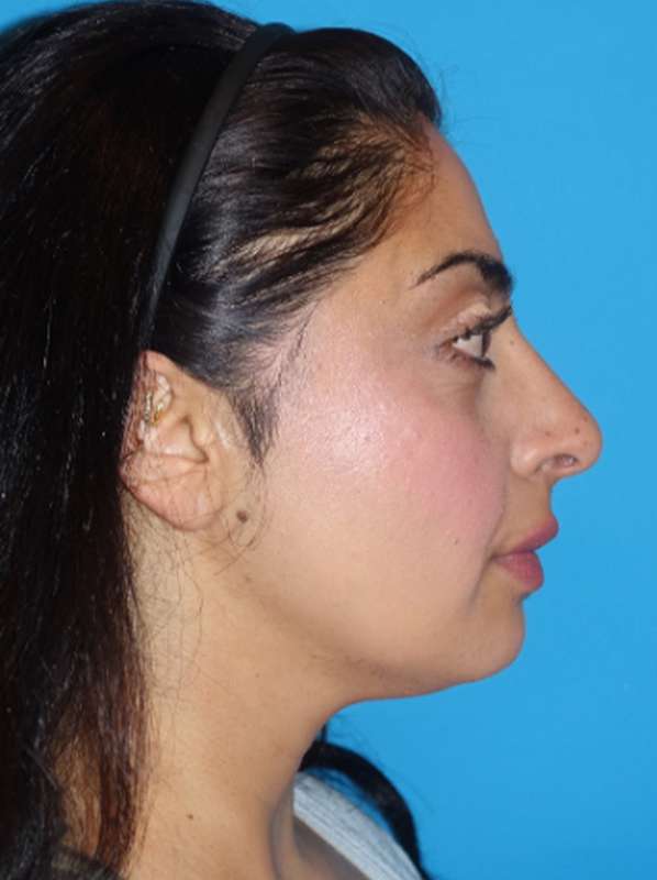 Rhinoplasty Before & After Patient #887