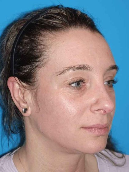 Rhinoplasty Before & After Patient #898