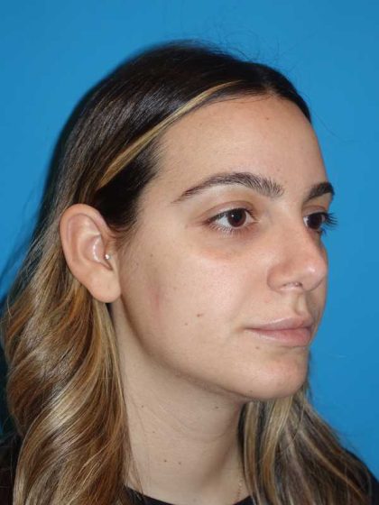 Rhinoplasty Before & After Patient #909