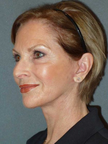 Deep Plane Lower Face & Neck Lift Before & After Patient #920
