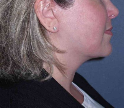 Deep Plane Lower Face & Neck Lift Before & After Patient #947