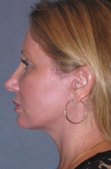 Deep Plane Mini Lift & Neck Lift Before & After Patient #981