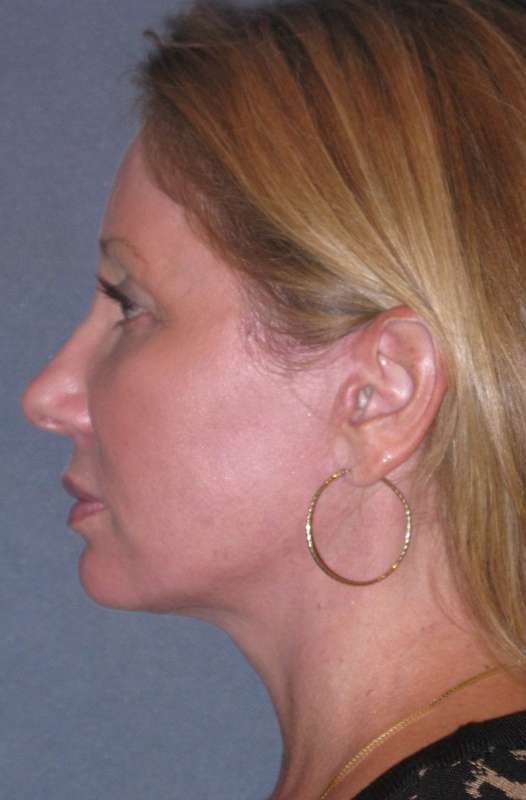 Deep Plane Mini Lift & Neck Lift Before & After Patient #981