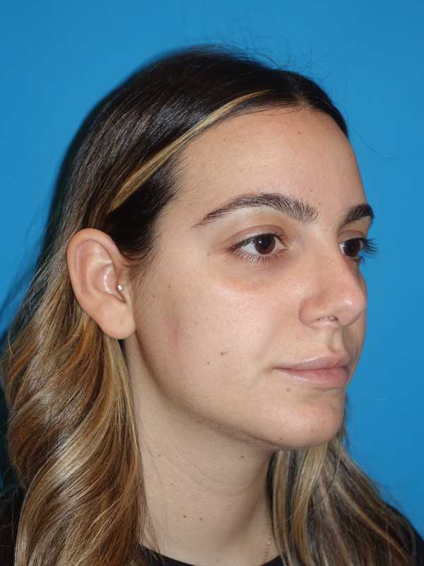 Neck Liposuction Before & After Patient #999